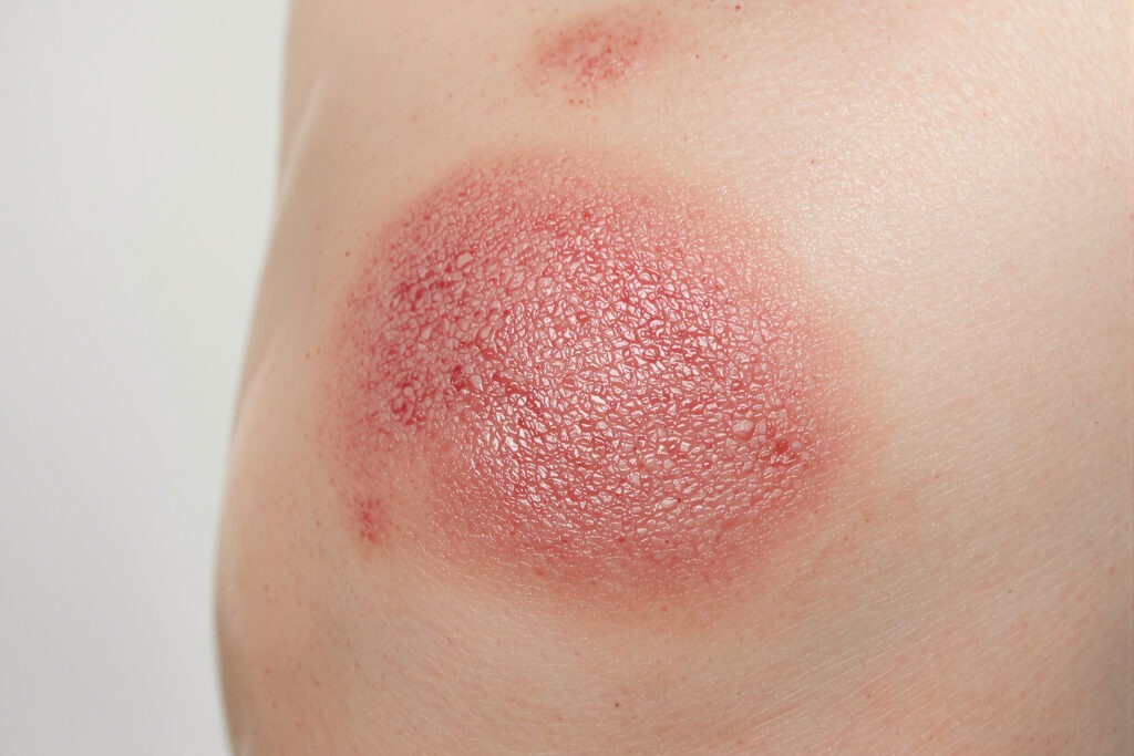 un genou avec une plaque d'eczéma