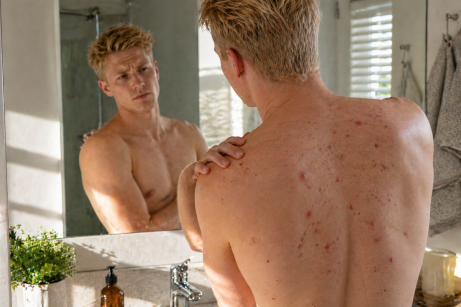 homme avec acné dans le dos devant un miroir dans une salle de bain