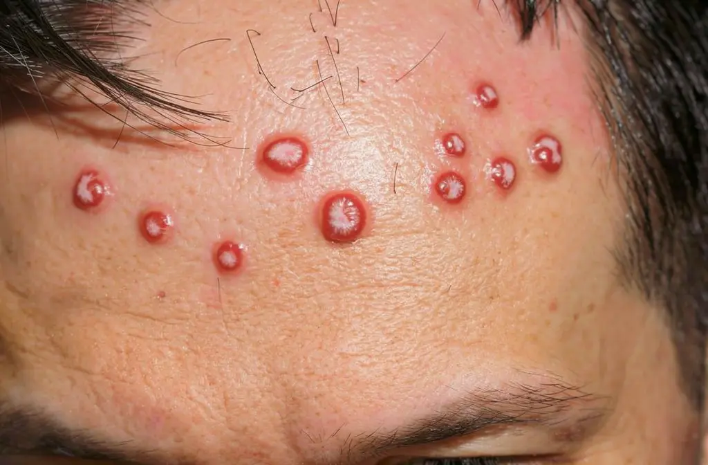 Psoriasis en goutte sur le front d'une personne, montrant des plaques rouges squameuses arrondies typiques.